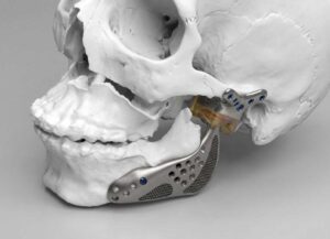 مدل سه‌بعدی آناتومیک پروتز شخصی‌سازی شده فک (TMJ) نصب شده روی مدل جمجمه با بدنه تیتانیومی متخلخل.