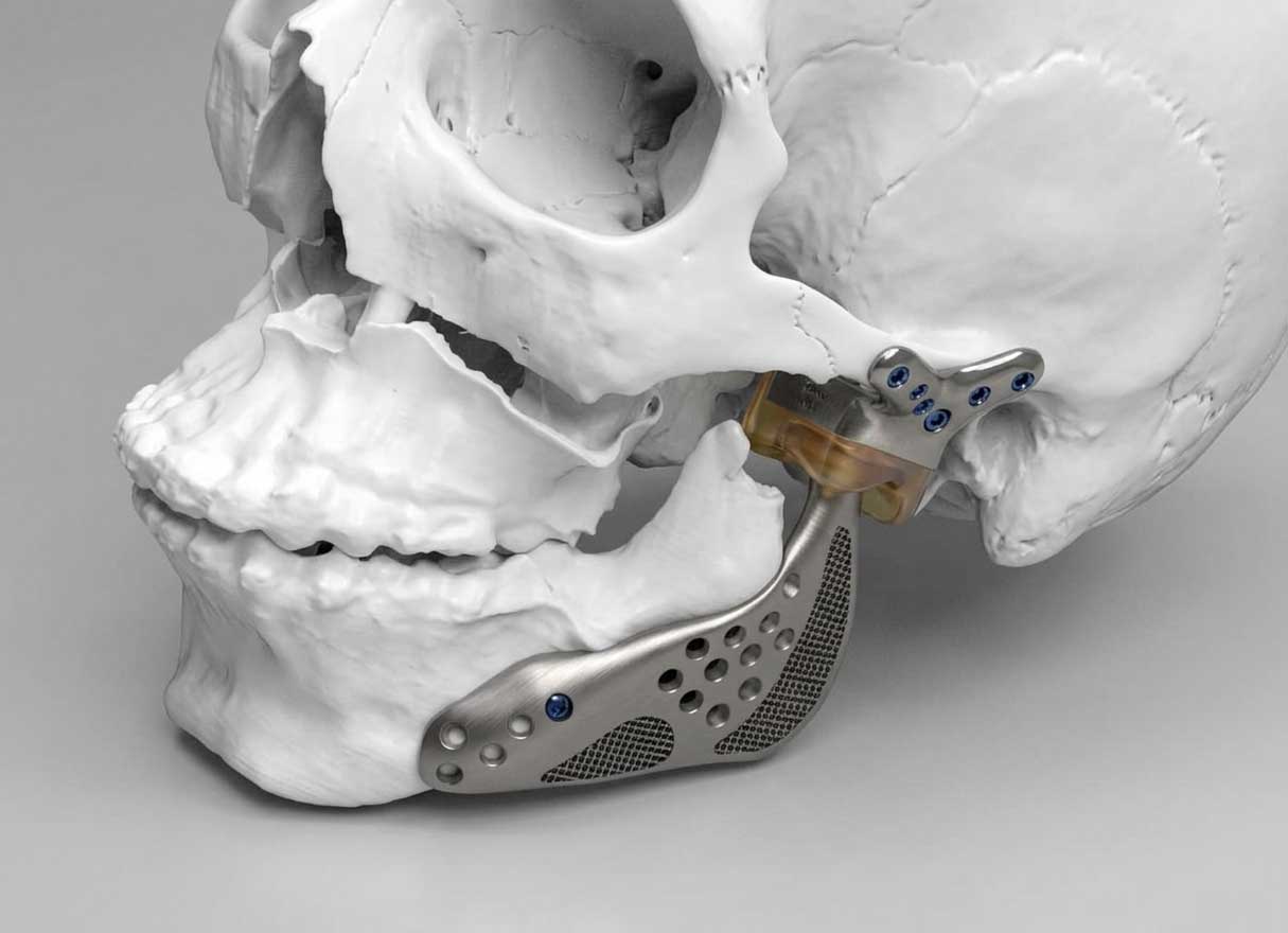مدل سه‌بعدی آناتومیک پروتز شخصی‌سازی شده فک (TMJ) نصب شده روی مدل جمجمه با بدنه تیتانیومی متخلخل.
