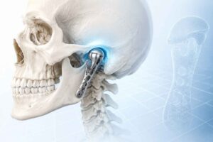 پروتز سفارشی TMJ ساخته شده با پرینت سه‌بعدی برای بازسازی مفصل فک