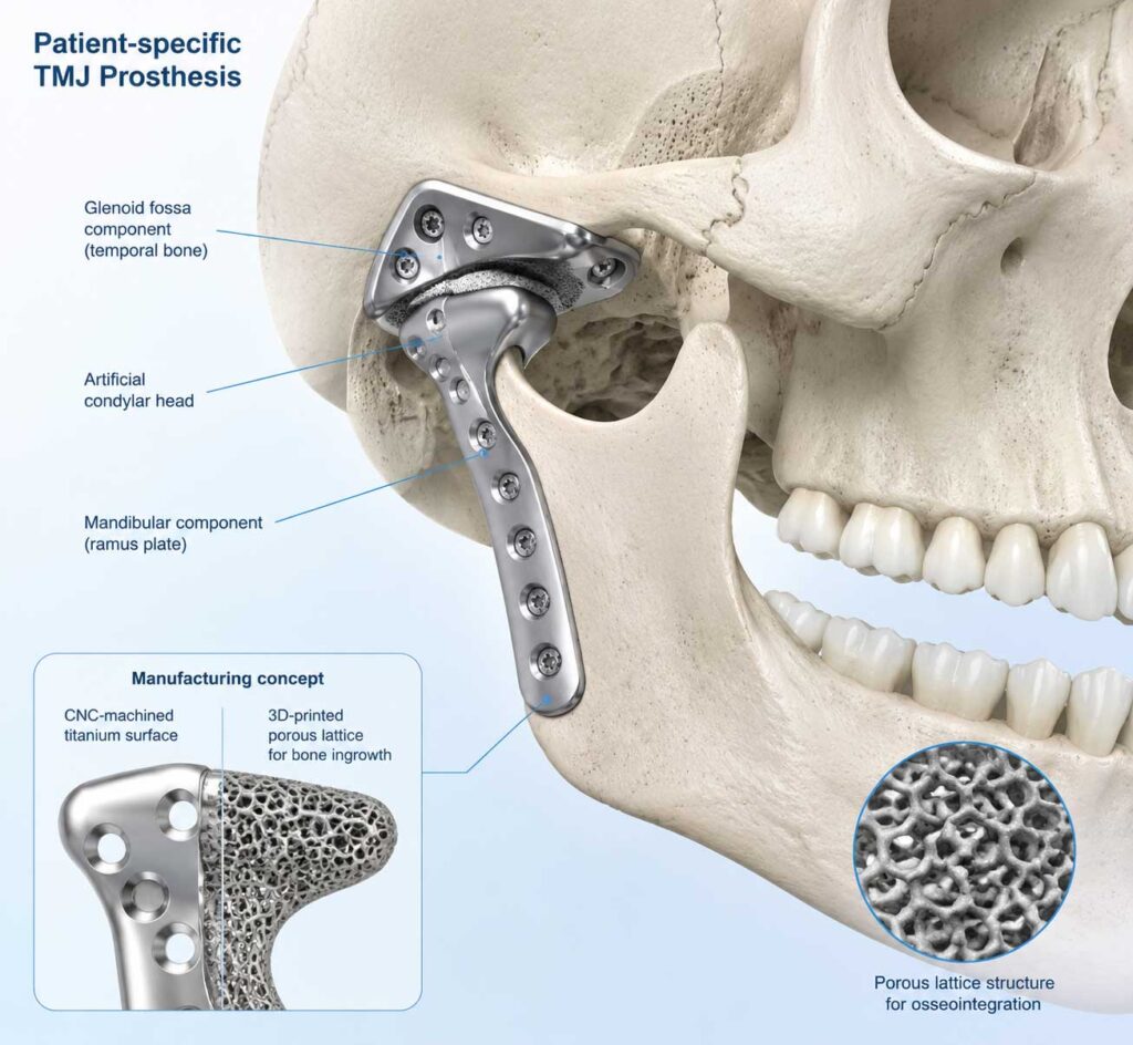 جزئیات مهندسی پروتز TMJ شامل ساختار متخلخل و اجزای مفصل گیجگاهی فکی