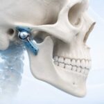 TMJ joint reconstruction illustration with titanium jaw joint prosthesis