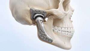 وفقیت در جراحی تعویض کامل مفصل فک با پروتز سفارشی (Total TMJ Replacement)