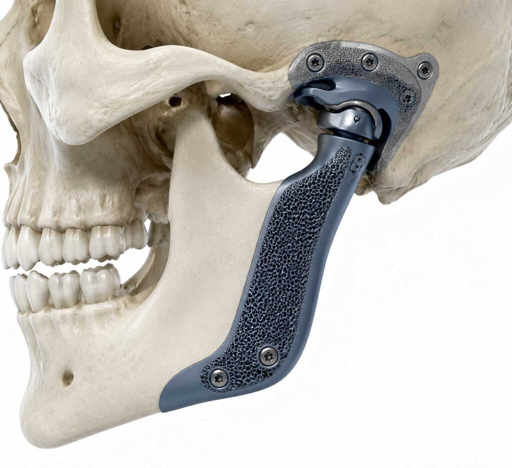 Patient-specific TMJ prosthesis replacing damaged mandibular condyle
